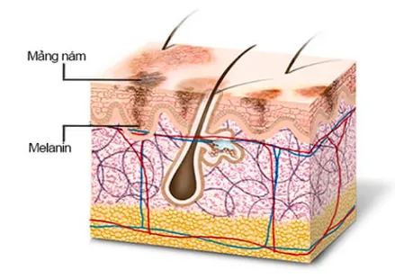 Nhận Diện Hình Ảnh Da Nám Thực Tế Để Phân Biệt Các Loại (nám Mảng, Chân Sâu, Đốm) Cho Chị Em