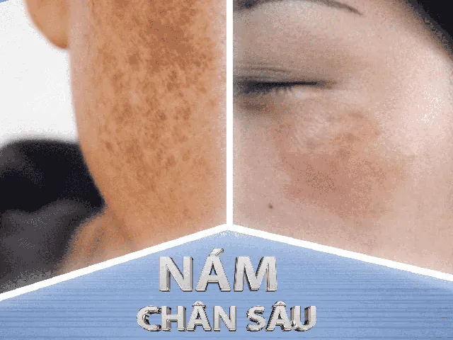 Nhận Diện Hình Ảnh Da Nám Thực Tế Để Phân Biệt Các Loại (nám Mảng, Chân Sâu, Đốm) Cho Chị Em
