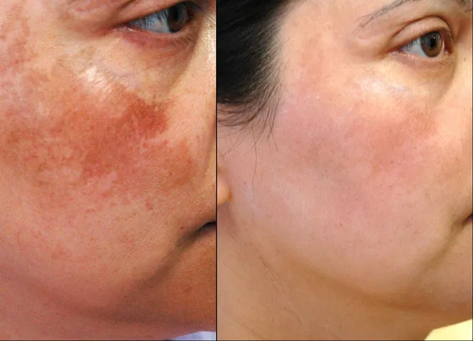Nhận Diện Hình Ảnh Da Nám Thực Tế Để Phân Biệt Các Loại (nám Mảng, Chân Sâu, Đốm) Cho Chị Em