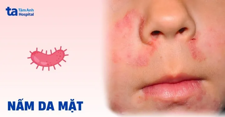 Nhận Diện Hình Ảnh Da Nám Thực Tế Để Phân Biệt Các Loại (nám Mảng, Chân Sâu, Đốm) Cho Chị Em