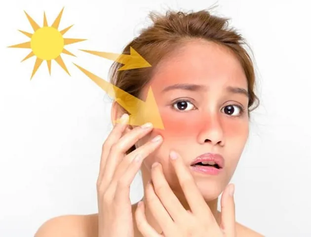 Nhận Diện Hình Ảnh Da Nám Thực Tế Để Phân Biệt Các Loại (nám Mảng, Chân Sâu, Đốm) Cho Chị Em
