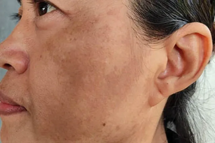 Nhận Diện Hình Ảnh Da Nám Thực Tế Để Phân Biệt Các Loại (nám Mảng, Chân Sâu, Đốm) Cho Chị Em