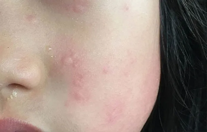Nhận Diện Hình Ảnh Da Nám Thực Tế Để Phân Biệt Các Loại (nám Mảng, Chân Sâu, Đốm) Cho Chị Em