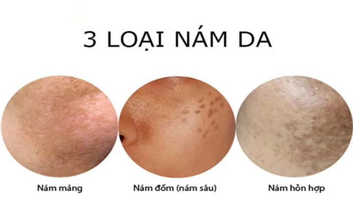 Nhận Diện Hình Ảnh Da Nám Thực Tế Để Phân Biệt Các Loại (nám Mảng, Chân Sâu, Đốm) Cho Chị Em