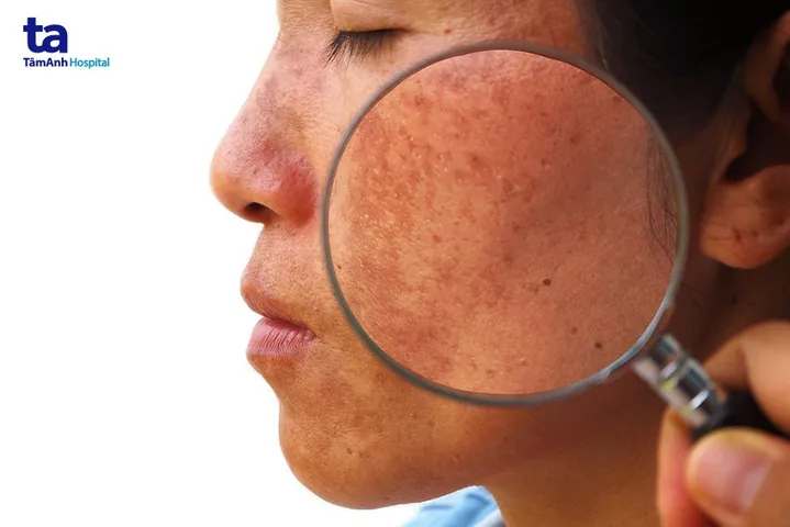 Nhận Diện Hình Ảnh Da Nám Thực Tế Để Phân Biệt Các Loại (nám Mảng, Chân Sâu, Đốm) Cho Chị Em