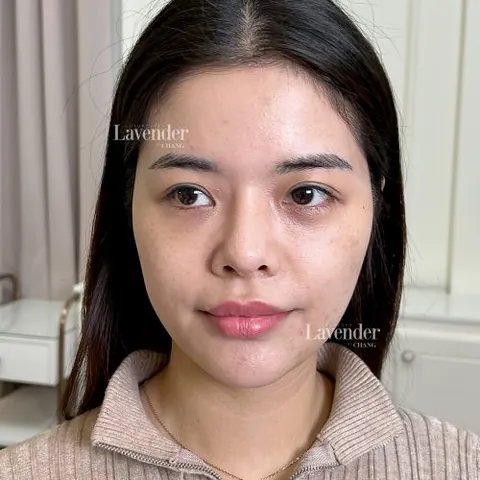 Nhận Diện Hình Ảnh Da Nám Thực Tế Để Phân Biệt Các Loại (nám Mảng, Chân Sâu, Đốm) Cho Chị Em