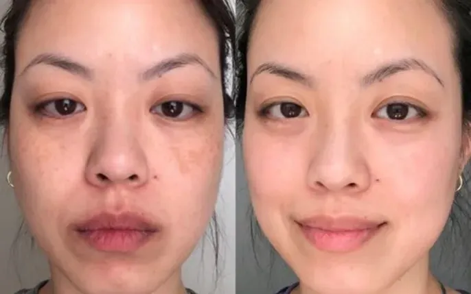Nhận Diện Hình Ảnh Da Nám Thực Tế Để Phân Biệt Các Loại (nám Mảng, Chân Sâu, Đốm) Cho Chị Em