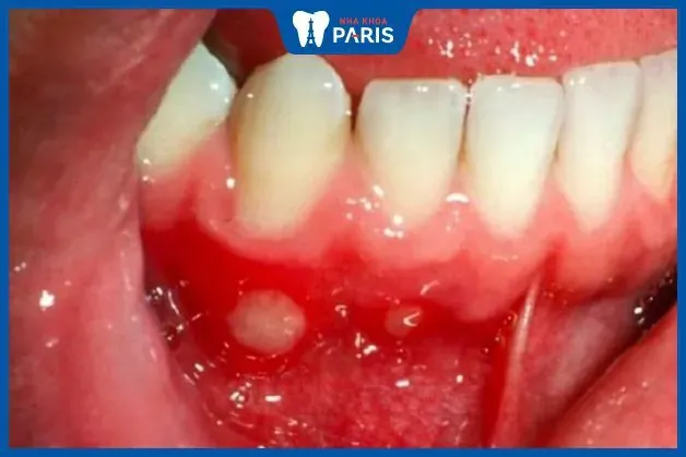 Xem Hình Ảnh Đẹn Miệng Theo Từng Vị Trí Để Nhận Biết Sớm Triệu Chứng Ở Người Lớn Và Trẻ Em Xem Hình Ảnh Đẹn Miệng Theo Từng Vị Trí Để Nhận Biết Sớm Triệu Chứng Ở Người Lớn Và Trẻ Em