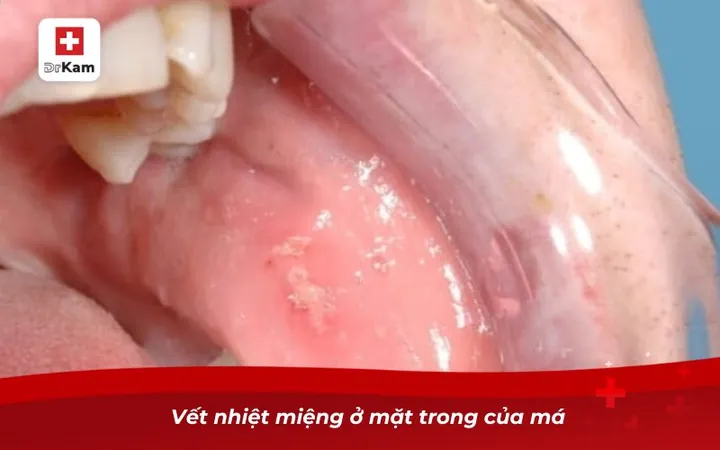 Xem Hình Ảnh Đẹn Miệng Theo Từng Vị Trí Để Nhận Biết Sớm Triệu Chứng Ở Người Lớn Và Trẻ Em Xem Hình Ảnh Đẹn Miệng Theo Từng Vị Trí Để Nhận Biết Sớm Triệu Chứng Ở Người Lớn Và Trẻ Em