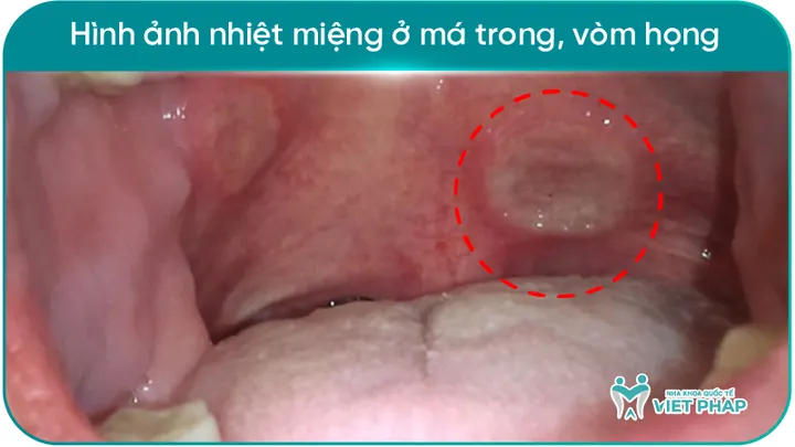 Xem Hình Ảnh Đẹn Miệng Theo Từng Vị Trí Để Nhận Biết Sớm Triệu Chứng Ở Người Lớn Và Trẻ Em Xem Hình Ảnh Đẹn Miệng Theo Từng Vị Trí Để Nhận Biết Sớm Triệu Chứng Ở Người Lớn Và Trẻ Em