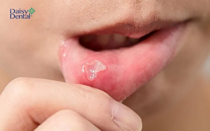 Xem Hình Ảnh Đẹn Miệng Theo Từng Vị Trí Để Nhận Biết Sớm Triệu Chứng Ở Người Lớn Và Trẻ Em Xem Hình Ảnh Đẹn Miệng Theo Từng Vị Trí Để Nhận Biết Sớm Triệu Chứng Ở Người Lớn Và Trẻ Em