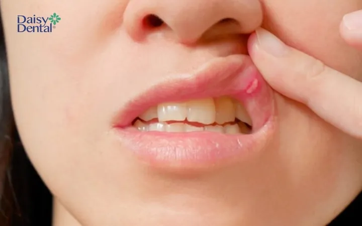 Xem Hình Ảnh Đẹn Miệng Theo Từng Vị Trí Để Nhận Biết Sớm Triệu Chứng Ở Người Lớn Và Trẻ Em Xem Hình Ảnh Đẹn Miệng Theo Từng Vị Trí Để Nhận Biết Sớm Triệu Chứng Ở Người Lớn Và Trẻ Em