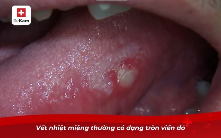 Xem Hình Ảnh Đẹn Miệng Theo Từng Vị Trí Để Nhận Biết Sớm Triệu Chứng Ở Người Lớn Và Trẻ Em Xem Hình Ảnh Đẹn Miệng Theo Từng Vị Trí Để Nhận Biết Sớm Triệu Chứng Ở Người Lớn Và Trẻ Em