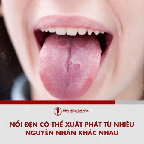Xem Hình Ảnh Đẹn Miệng Theo Từng Vị Trí Để Nhận Biết Sớm Triệu Chứng Ở Người Lớn Và Trẻ Em Xem Hình Ảnh Đẹn Miệng Theo Từng Vị Trí Để Nhận Biết Sớm Triệu Chứng Ở Người Lớn Và Trẻ Em