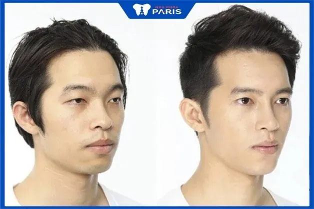 Xem Hình Ảnh Độn Cằm Thực Tế Và So Sánh Các Dáng Cằm Sau Thẩm Mỹ Cho Người Mới Tìm Hiểu