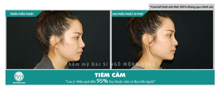 Xem Hình Ảnh Độn Cằm Thực Tế Và So Sánh Các Dáng Cằm Sau Thẩm Mỹ Cho Người Mới Tìm Hiểu