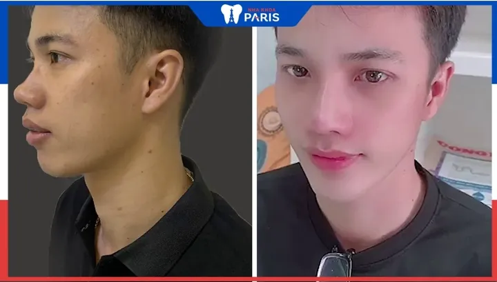 Xem Hình Ảnh Độn Cằm Thực Tế Và So Sánh Các Dáng Cằm Sau Thẩm Mỹ Cho Người Mới Tìm Hiểu