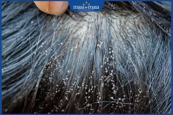 Hình Ảnh Gàu: Nhận Diện, Phân Biệt & Xử Lý Nhanh Chóng Cho Người Mắc Đầu Hình Ảnh Gàu: Nhận Diện, Phân Biệt & Xử Lý Nhanh Chóng Cho Người Mắc Đầu