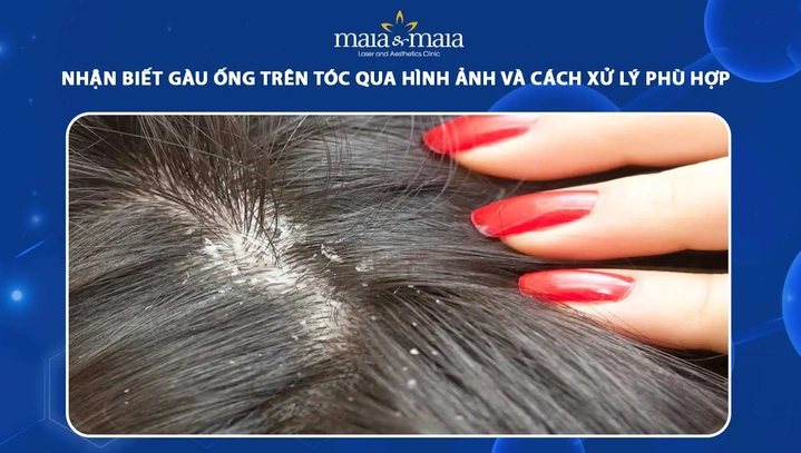 Hình Ảnh Gàu: Nhận Diện, Phân Biệt & Xử Lý Nhanh Chóng Cho Người Mắc Đầu Hình Ảnh Gàu: Nhận Diện, Phân Biệt & Xử Lý Nhanh Chóng Cho Người Mắc Đầu