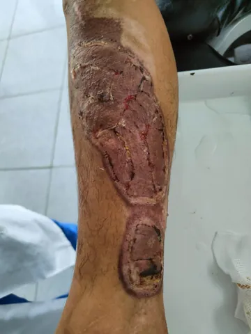 Xem Hình Ảnh Ghép Da Và Các Loại Phương Pháp Phẫu Thuật Cho Bệnh Nhân