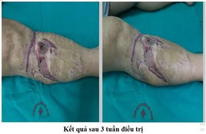 Xem Hình Ảnh Ghép Da Và Các Loại Phương Pháp Phẫu Thuật Cho Bệnh Nhân