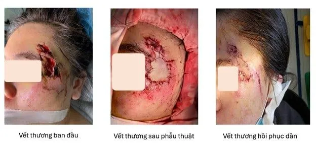 Xem Hình Ảnh Ghép Da Và Các Loại Phương Pháp Phẫu Thuật Cho Bệnh Nhân