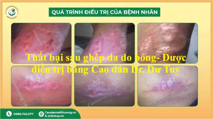 Xem Hình Ảnh Ghép Da Và Các Loại Phương Pháp Phẫu Thuật Cho Bệnh Nhân