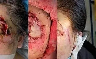 Xem Hình Ảnh Ghép Da Và Các Loại Phương Pháp Phẫu Thuật Cho Bệnh Nhân