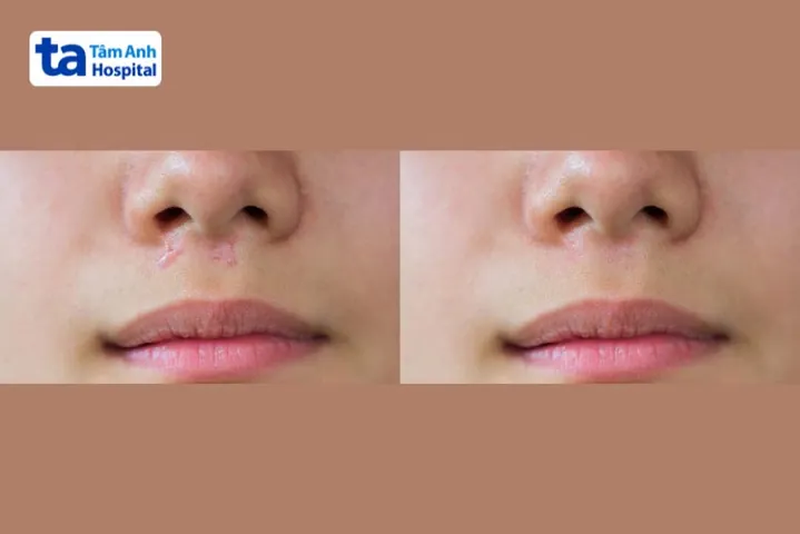 Xem Hình Ảnh Ghép Da Và Các Loại Phương Pháp Phẫu Thuật Cho Bệnh Nhân