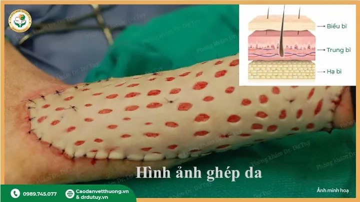Xem Hình Ảnh Ghép Da Và Các Loại Phương Pháp Phẫu Thuật Cho Bệnh Nhân