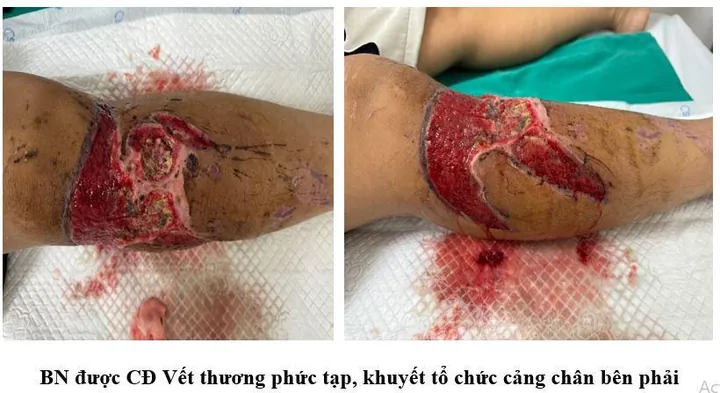 Xem Hình Ảnh Ghép Da Và Các Loại Phương Pháp Phẫu Thuật Cho Bệnh Nhân