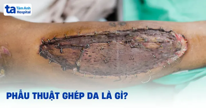 Xem Hình Ảnh Ghép Da Và Các Loại Phương Pháp Phẫu Thuật Cho Bệnh Nhân