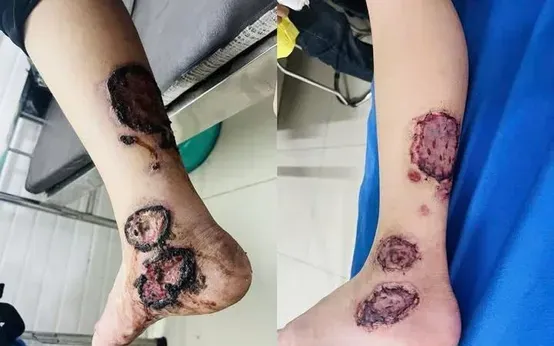 Xem Hình Ảnh Ghép Da Và Các Loại Phương Pháp Phẫu Thuật Cho Bệnh Nhân