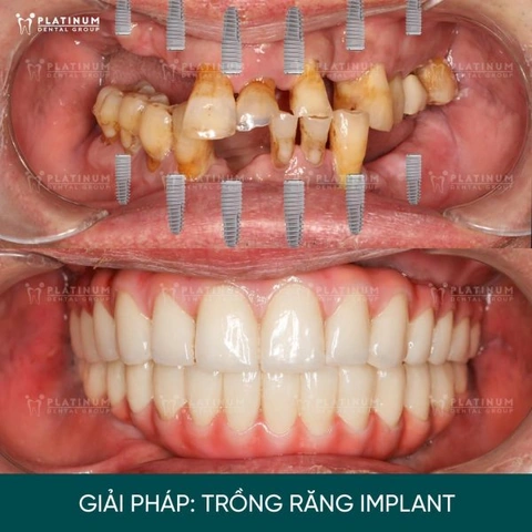 Hình Ảnh Implant: Quy Trình Chi Tiết & Kết Quả Trước‑sau Cho Người Mới Tìm Hiểu