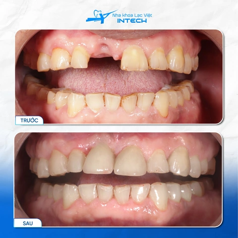 Hình Ảnh Implant: Quy Trình Chi Tiết & Kết Quả Trước‑sau Cho Người Mới Tìm Hiểu