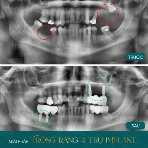 Hình Ảnh Implant: Quy Trình Chi Tiết & Kết Quả Trước‑sau Cho Người Mới Tìm Hiểu