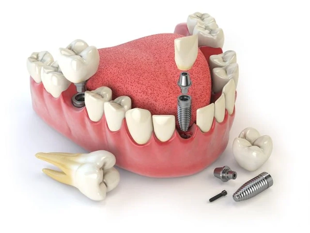 Hình Ảnh Implant: Quy Trình Chi Tiết & Kết Quả Trước‑sau Cho Người Mới Tìm Hiểu