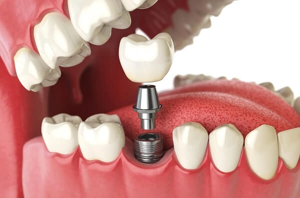 Hình Ảnh Implant: Quy Trình Chi Tiết & Kết Quả Trước‑sau Cho Người Mới Tìm Hiểu