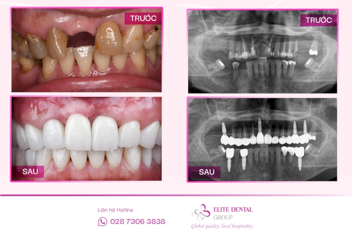 Hình Ảnh Implant: Quy Trình Chi Tiết & Kết Quả Trước‑sau Cho Người Mới Tìm Hiểu