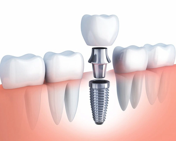 Hình Ảnh Implant: Quy Trình Chi Tiết & Kết Quả Trước‑sau Cho Người Mới Tìm Hiểu