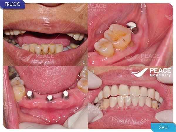 Hình Ảnh Implant: Quy Trình Chi Tiết & Kết Quả Trước‑sau Cho Người Mới Tìm Hiểu