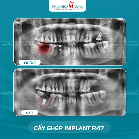 Hình Ảnh Implant: Quy Trình Chi Tiết & Kết Quả Trước‑sau Cho Người Mới Tìm Hiểu