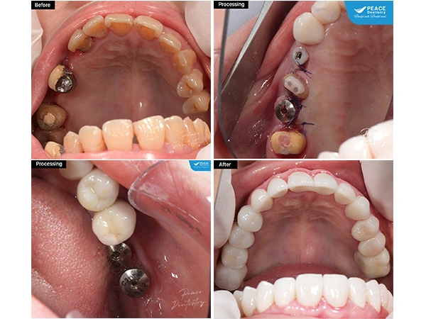 Hình Ảnh Implant: Quy Trình Chi Tiết & Kết Quả Trước‑sau Cho Người Mới Tìm Hiểu