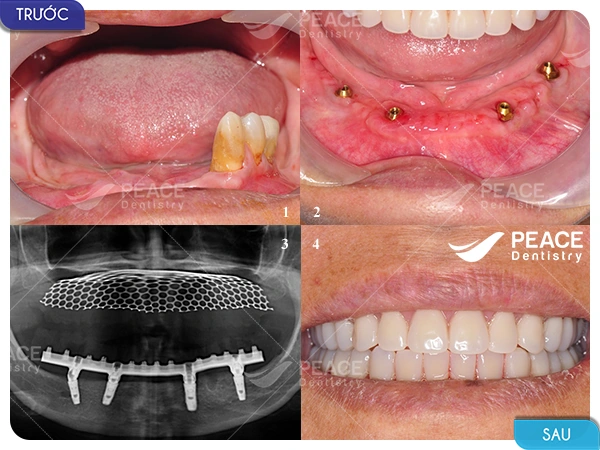 Hình Ảnh Implant: Quy Trình Chi Tiết & Kết Quả Trước‑sau Cho Người Mới Tìm Hiểu