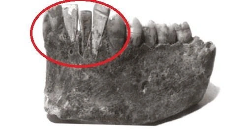 Hình Ảnh Implant: Quy Trình Chi Tiết & Kết Quả Trước‑sau Cho Người Mới Tìm Hiểu