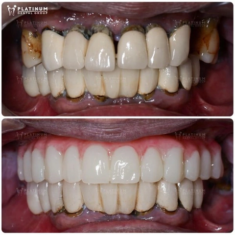 Hình Ảnh Implant: Quy Trình Chi Tiết & Kết Quả Trước‑sau Cho Người Mới Tìm Hiểu