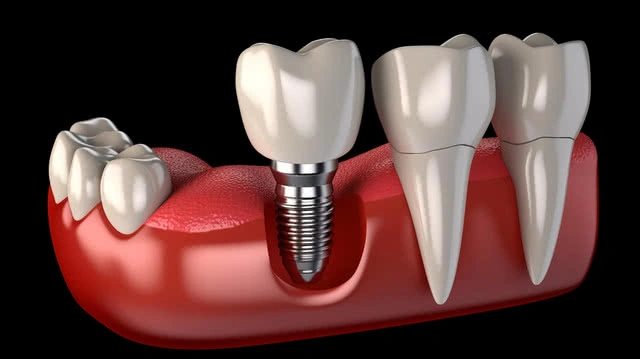Hình Ảnh Implant: Quy Trình Chi Tiết & Kết Quả Trước‑sau Cho Người Mới Tìm Hiểu