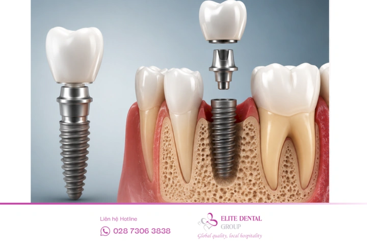 Hình Ảnh Implant: Quy Trình Chi Tiết & Kết Quả Trước‑sau Cho Người Mới Tìm Hiểu