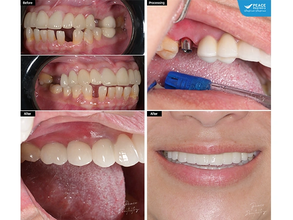 Hình Ảnh Implant: Quy Trình Chi Tiết & Kết Quả Trước‑sau Cho Người Mới Tìm Hiểu