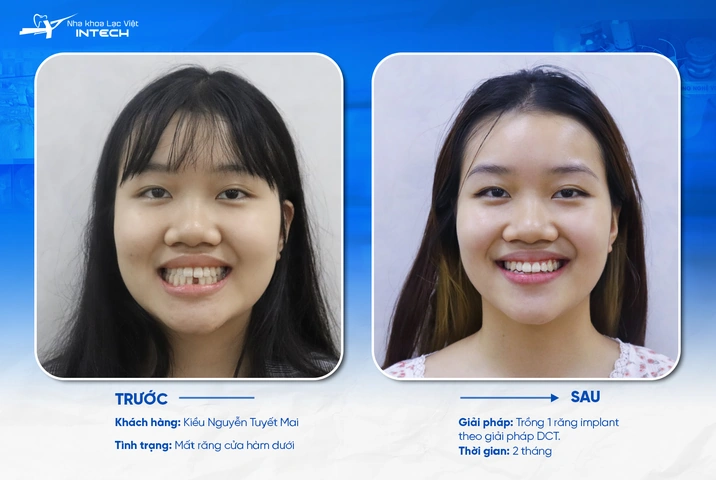 Hình Ảnh Implant: Quy Trình Chi Tiết & Kết Quả Trước‑sau Cho Người Mới Tìm Hiểu